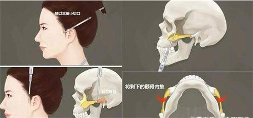 北京米兰柏羽激光修复痘坑——个性化的治疗方案