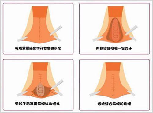 2. 合肥曙光植发头顶加密种植——个性化的植发方案