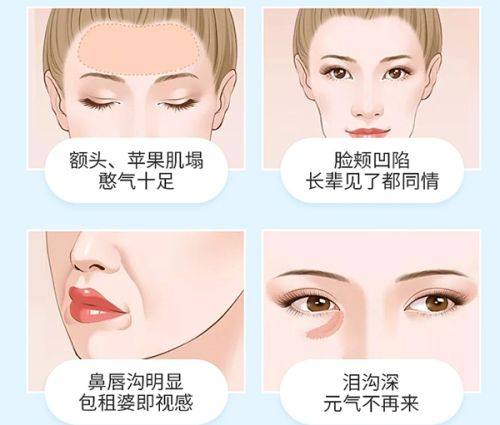 北京米兰柏羽激光修复痘坑——优质的服务体验