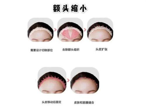 北京米兰柏羽黄金微针体验：正规授权带来安心有效的焕肤成效 