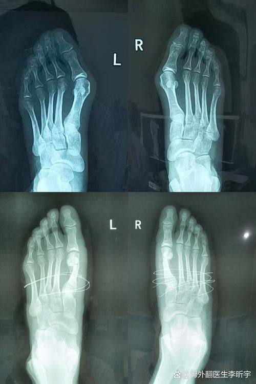 三、上海虹桥医院大脚骨手术个性化方案选择