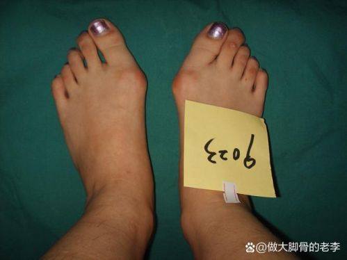 四、上海虹桥医院大脚骨手术术后管理