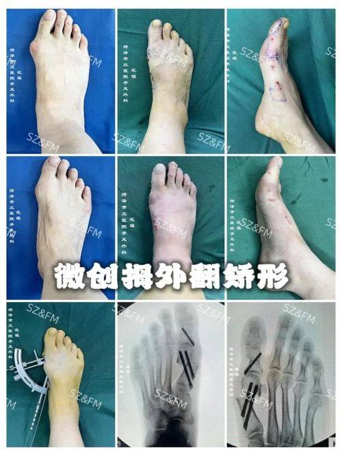 五、选择上海虹桥医院大脚骨手术的三大理由