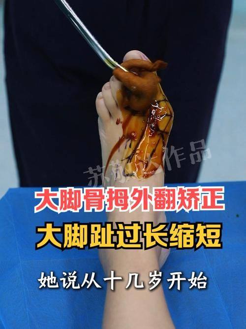 一、上海虹桥医院大脚骨手术的技术突破