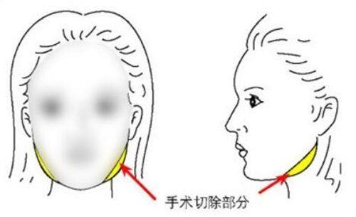 东莞非凡整形美容医院口碑如何？