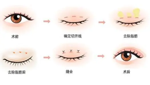 二、重点推荐三家优质去眼袋医院