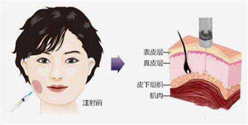 广东中山美南华超声炮8980元起，排名前列医院带来舒适体验与显著抗衰效果 