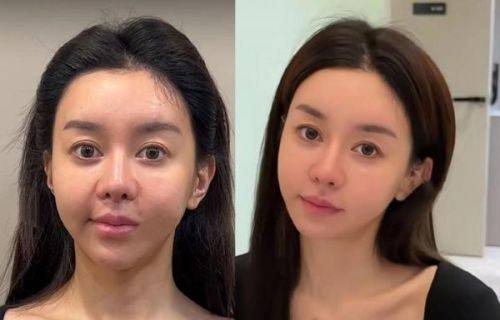 二、打了生长因子三年后疯长的典型症状
