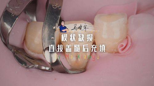 2. 深圳美莱口腔树脂补牙——材料优质