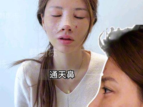 长沙亚韩医学美容医院郑京湘医生操刀，硅胶假体隆鼻6000元起，效果自然持久！ 