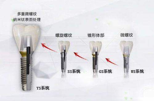 4. 泸州尚好口腔单颗种植牙：优质的服务和配套设施