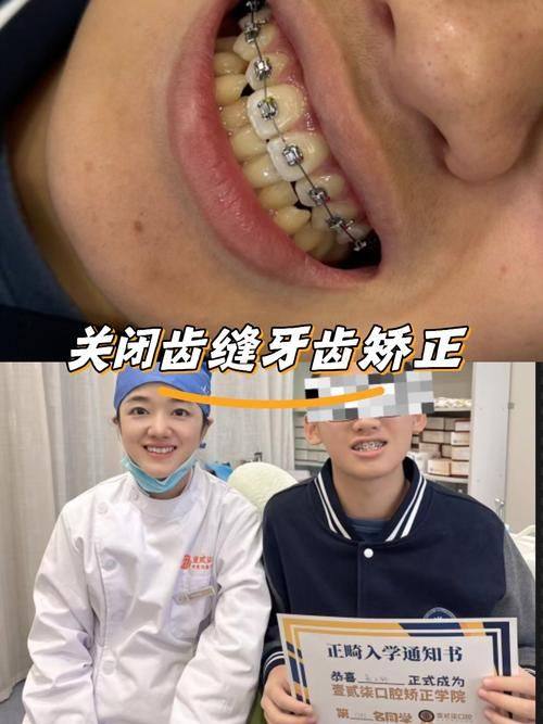 亲历！带娃在福州维乐口腔找罗罡医生做了早期干预矫正，简化流程缩短周期成效棒 