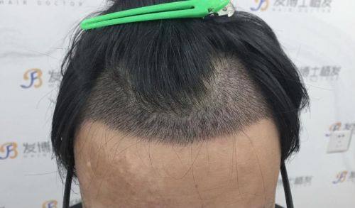 南京新生植发医疗美容门诊部特色项目：