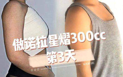杭州艺星李俊霞医生专精双眼皮整形总结