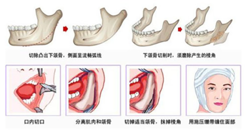五、西安激光脱毛哪个医院更好？瑞丽医美性价比高