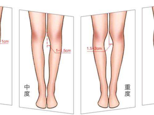 三、杭州艺星做双眼皮哪个医生好？典型病例分析