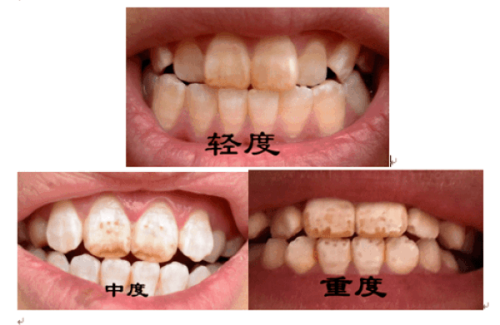 芜湖伊莱美口腔价格表曝光！种牙1880元起，矫正3680元起，拔牙25元