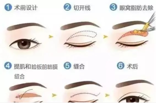 二、杭州艺星做双眼皮哪个医生好？手术方案差异