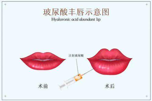 双眼皮术后护理秘籍