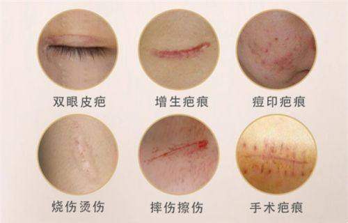 上海九院做双眼皮医生排名之复合矫正派