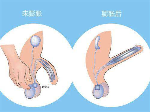 亲历北京润美玉之光王明利医生肩膀吸脂：小创口技术助我快速拥有纤美香肩 