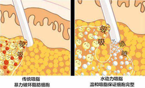 2. 济南艺星激光去红血丝之精良设备