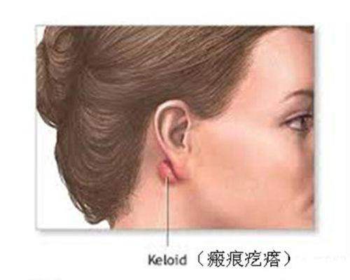 三、深圳张辉隆鼻技术怎么样?个性化手术方案制定