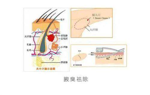 5. 济南艺星激光修复痘坑之专精服务