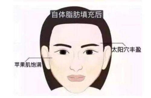 亲历北京润美玉之光王明利医生大腿吸脂，轻松拥有流畅自然美腿！ 