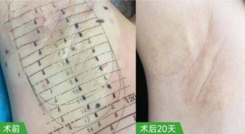 六、李广学医生去川字纹真皮填充技术适用人群与风险把控