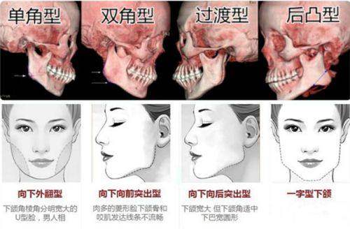 二、成都西区医院抽脂术后管理新标准