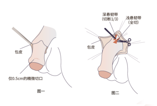 4. 北京雅靓激光脱毛之成效优势