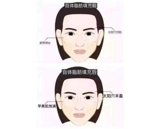 3. 北京雅靓激光祛痘印之服务流程优势