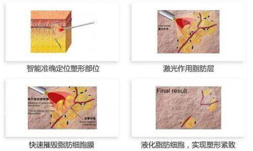 二、深圳米兰柏羽医疗美容医院怎么样？