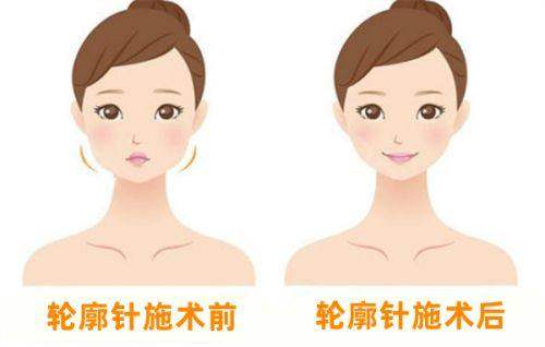 十二、广州打伊妍仕少女针一支多少钱价格
