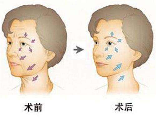 二、北京XX医院骨水泥颅顶填充术全过程特色