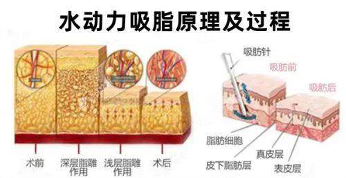 四、一线城市阴道紧缩针多少钱一针