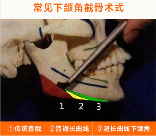 韩国菲斯莱茵faceline整形医院收费价格表：