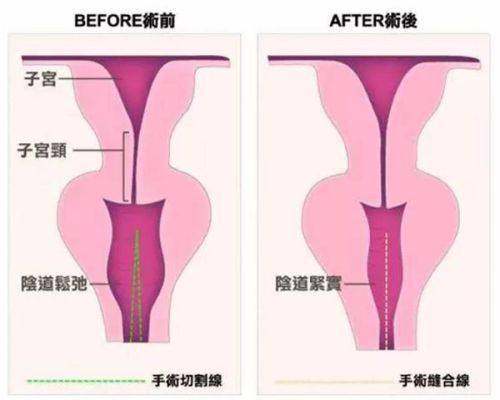 四、南京美莱整形医生夏建军技术解析