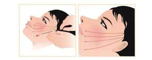 隆胸项目详解