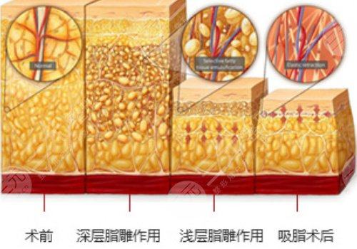 影响胳膊吸脂价格的因素?：